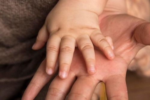 Bệnh viện Sản Nhi tỉnh Vĩnh Phúc phẫu thuật thành công cho bệnh nhi dính ngón tay bẩm sinh
