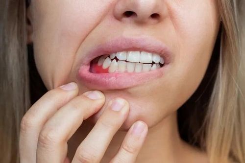 Vì sao có hiện tượng tụt nướu, có phục hồi được không?