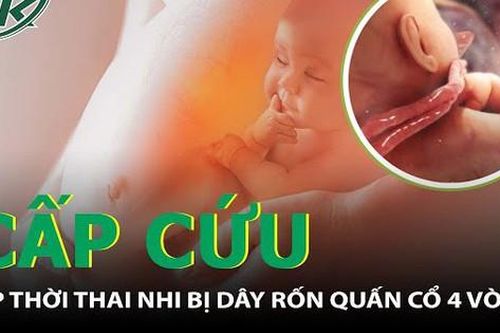 Kịp thời mổ cấp cứu thai nhi bị dây rốn quấn cổ 4 vòng