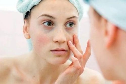Quầng thâm mắt không chỉ do thiếu ngủ mà còn cảnh báo bệnh nguy hiểm