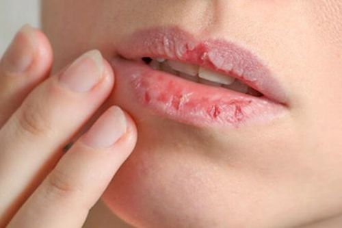 Làm thế nào để thoát khỏi môi nứt nẻ trong mùa đông?
