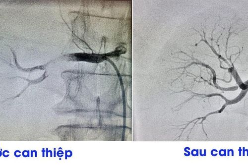 Nhồi máu thận được điều trị khỏi nhờ kỹ thuật can thiệp thường quy