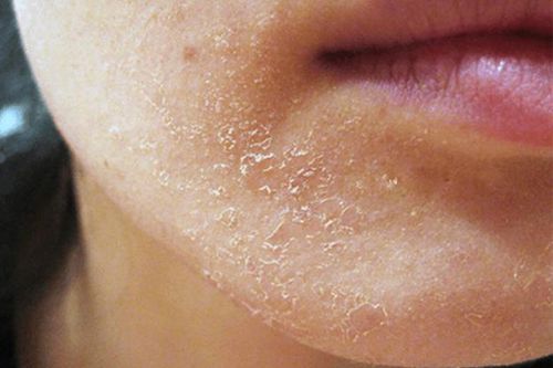 Cách trị bong tróc da mặt