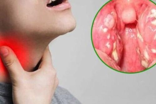 Cần phát hiện sớm bệnh bạch hầu để tránh gây tử vong