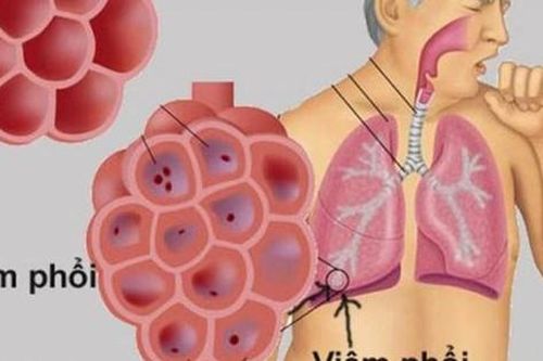 Mẹo kiểm soát bệnh viêm phổi mùa đông