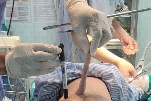 Bé trai 4 tháng tuổi có đuôi dài 14cm