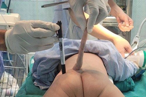Cắt bỏ thành công đuôi dị tật bẩm sinh dài 14 cm