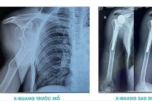 Lần đầu tiên Bệnh viện 199 thực hiện thành công phẫu thuật thay khớp vai toàn phần đảo ngược