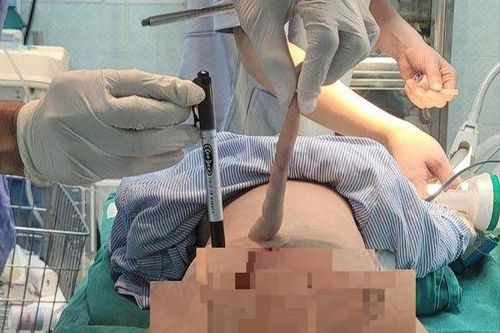 Trẻ sinh ra đã có đuôi dị tật bẩm sinh hiếm gặp, cha mẹ cần làm gì để ngăn ngừa dị tật sơ sinh?
