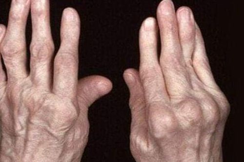 Điều trị sớm viêm khớp dạng thấp để tránh tàn phế