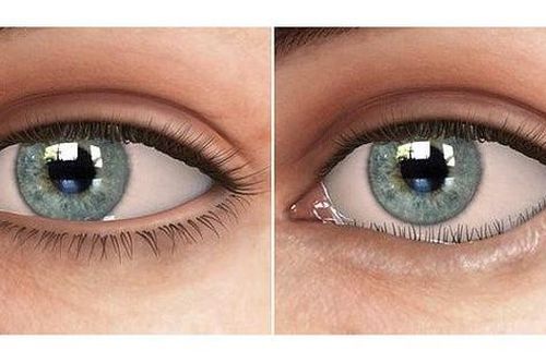 Bác sĩ chuyên khoa chỉ cách xử lý lông mi quặm