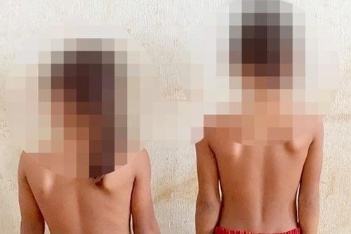 Báo động tình trạng cong, vẹo cột sống ở học sinh