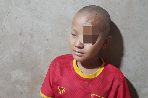 Tính mạng mong manh của cậu bé bị ung thư đến biến dạng khuôn mặt
