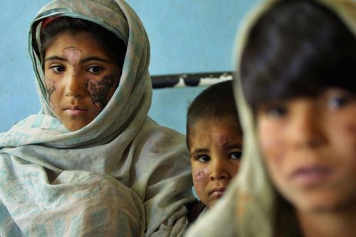 WHO ứng phó với dịch bệnh Leishmania 'chưa từng có' ở Ethiopia