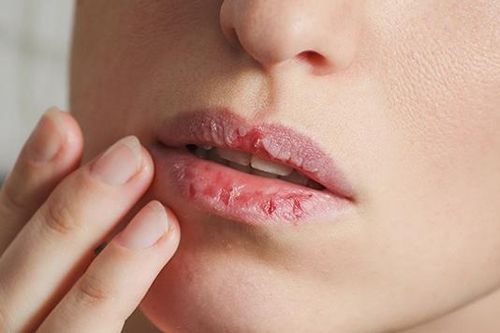 Cách khắc phục cho đôi môi nứt nẻ vào mùa đông