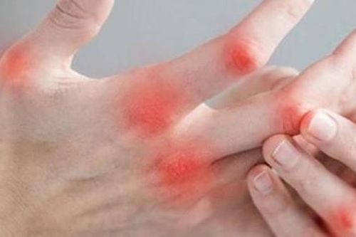 Bài thuốc đông y trị đau nhức khớp