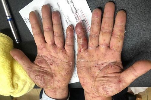 Nghĩ ngứa da do thời tiết, đi khám cả nhà phát hiện mắc ghẻ