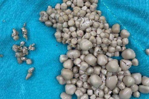 Cô gái có hơn 300 viên sỏi trong thận vì thói quen của nhiều người trẻ