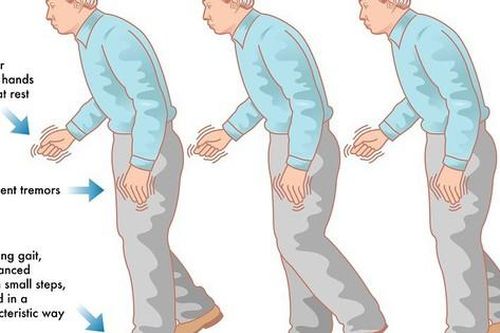 Dùng thuốc điều trị bệnh Parkinson cần lưu ý những gì?