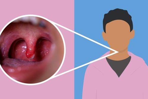 Lưỡi gà là gì? Lưỡi gà bị sưng là do đâu?