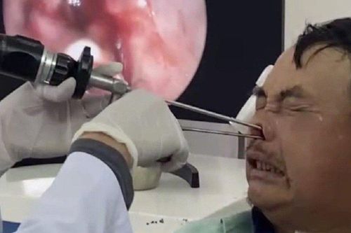 Hay làm điều này, người đàn ông bị 100 con giòi làm tổ trong mũi