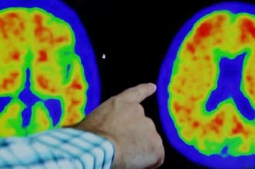 Thuốc mới mang đến hi vọng chữa bệnh Alzheimer từ năm 2024