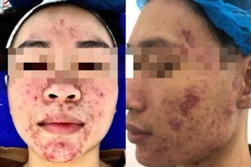 Dùng mỹ phẩm không rõ nguồn gốc, nhiều bạn trẻ bị 'nát mặt'