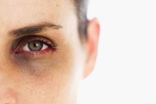 Cách giúp loại bỏ quầng thâm mắt