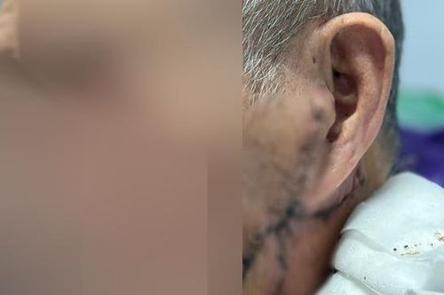 Hà Nội: Cắt u tuyến dưới hàm 'khổng lồ' bị hoại tử cho bệnh nhân cao tuổi