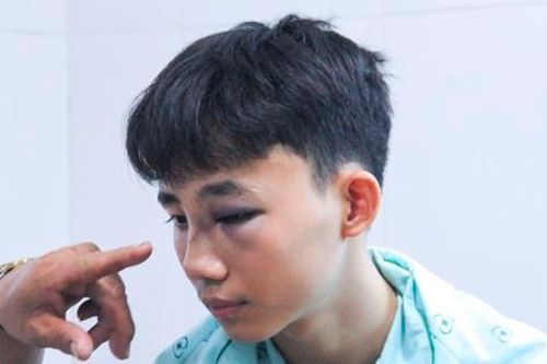 Bình Định: Học sinh lớp 10 bị đánh hội đồng nhập viện