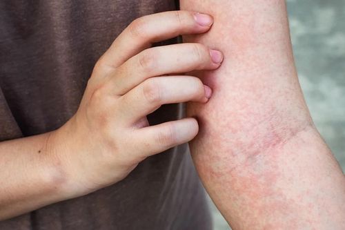 8 dấu hiệu cảnh báo thận đang 'quá tải'
