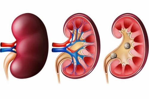 Những loại nước ngăn ngừa sỏi thận không thể bỏ qua