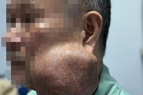 Suýt mất mạng vì mang khối u khổng lồ 30 năm không điều trị