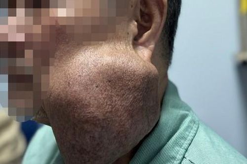 Cụ ông phải trải qua cuộc đại phẫu vì để khối u góc hàm vỡ chảy máu mới đến bệnh viện