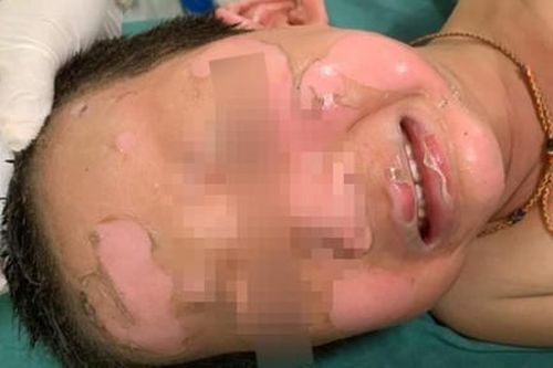 Bóng bay gặp tia lửa phát nổ, bé trai 4 tuổi bỏng toàn mặt