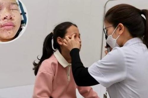 Bé gái tự chế pháo bằng diêm dẫn đến tổn thương 2 mắt, bỏng mặt