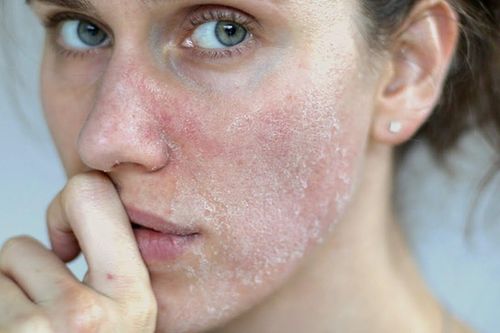 Bác sĩ mách bí quyết ngừa da nứt nẻ, bong tróc khi trời lạnh