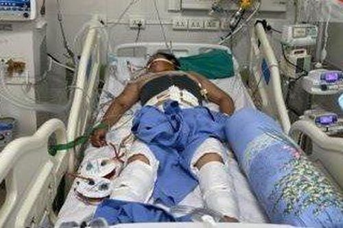 Bệnh nhân 49 tuổi 'sốc chồng sốc' do tai nạn giao thông nguy kịch và sốt xuất huyết Dengue
