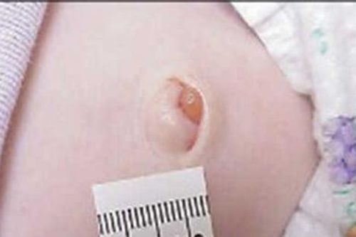 6 dấu hiệu bất thường ở rốn báo hiệu trẻ có vấn đề sức khỏe