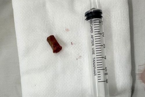 Dị vật bỏ quên 7 năm, đi 5 bệnh viện mới lấy ra được
