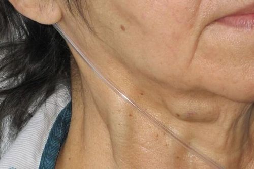 Giãn tĩnh mạch ở cổ là gì? Tình trạng này có nguy hiểm không?