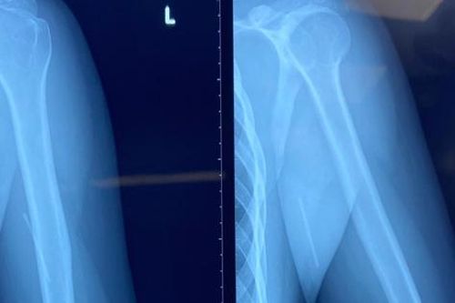 Que tránh tay đi lạc, dấu hiệu cần can thiệp sớm