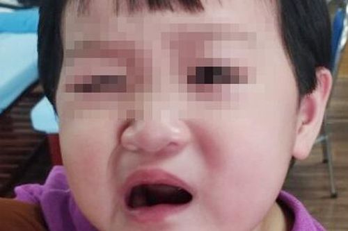 Bé 24 tháng tuổi liệt dây thần kinh số VII khi thời tiết giao mùa