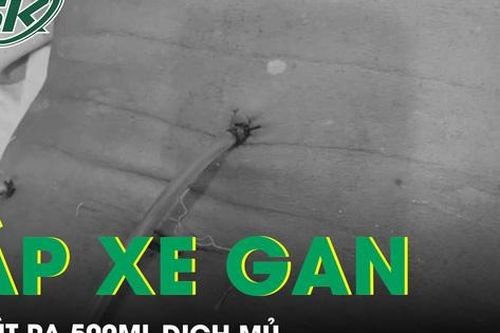 Áp xe gan hút ra 500ml dịch mủ