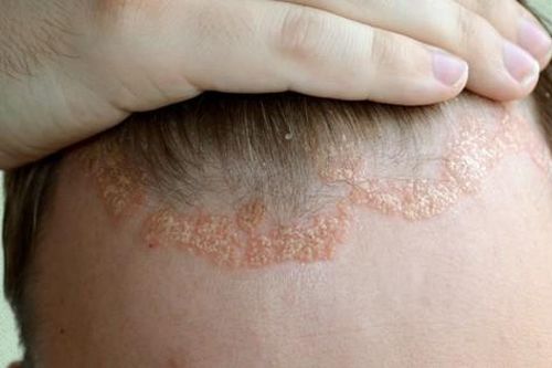 Thuốc bôi mới dạng bọt trị viêm da đầu