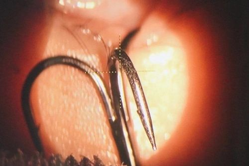 Bé trai bị lưỡi câu móc vào mắt khi đùa giỡn