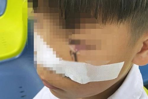 Cấp cứu bé trai 11 tuổi bị lưỡi câu sắc nhọn móc vào mắt khi đùa giỡn