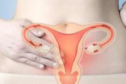 Lạc nội mạc tử cung có thể gây vô sinh?