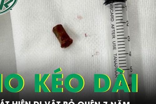 Ho kéo dài, bàng hoàng phát hiện dị vật 7 năm bỏ quên