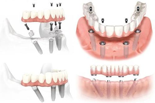 Những điều bạn cần biết về kỹ thuật cấy ghép Implant